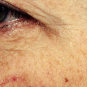 A closeup image of a middle aged woman's cheek and eye, highlighting reduced wrinkles in the eye area.
