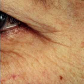 A closeup image of a middle aged woman's cheek and eye, highlighting wrinkles in the eye area.
