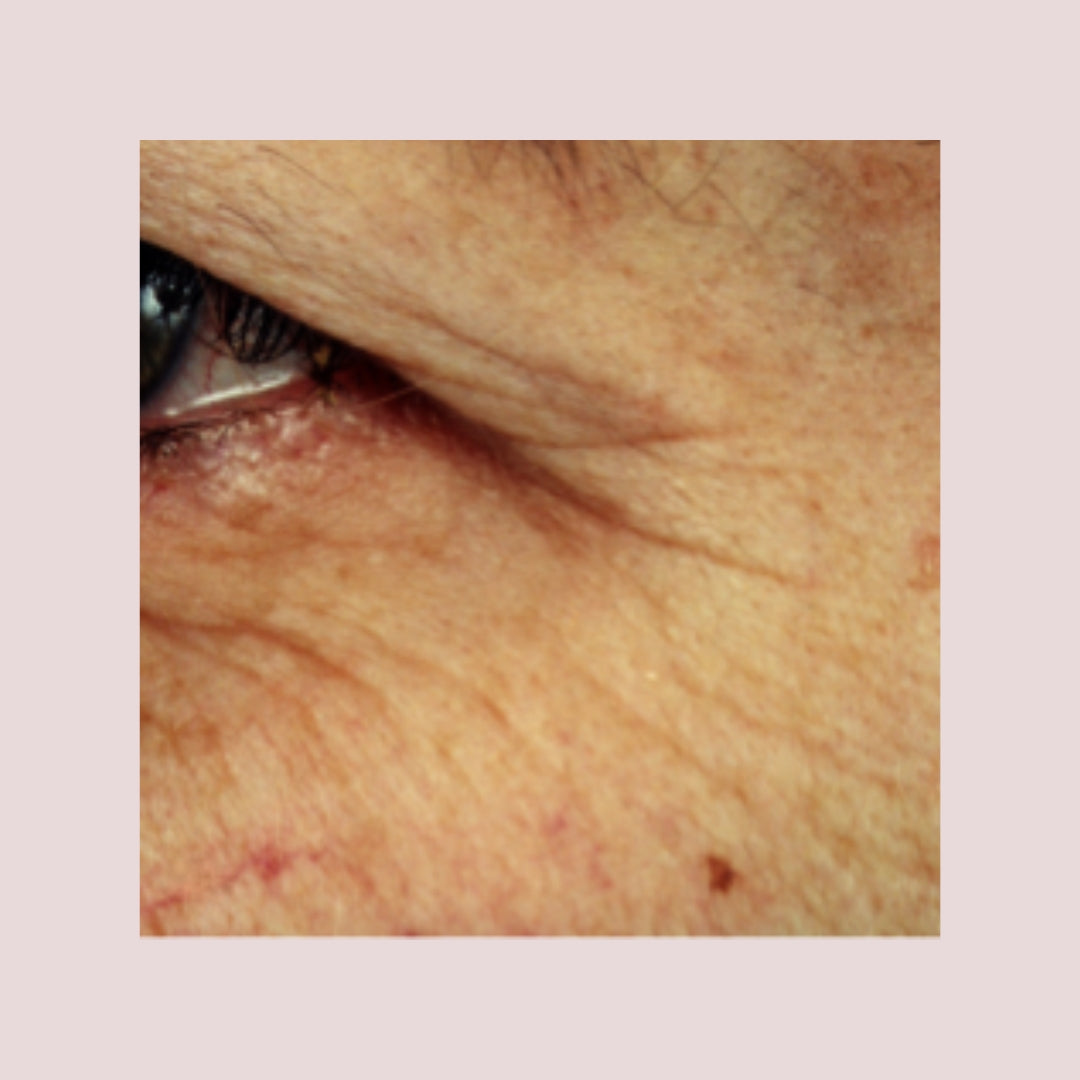 A closeup image of a middle aged woman's cheek and eye, highlighting reduced wrinkles in the eye area.
