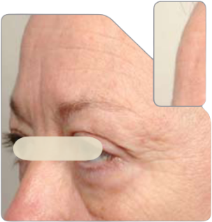 A closeup image of a middle aged woman's face, highlighting reduced wrinkles and smooth skin in the forehead and eye areas.
