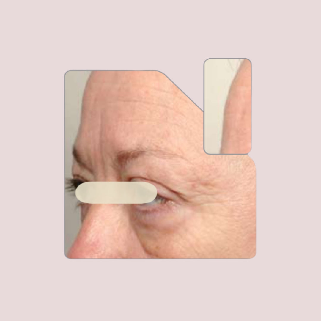 A closeup image of a middle aged woman's face, highlighting reduced wrinkles and smooth skin in the forehead and eye areas.
