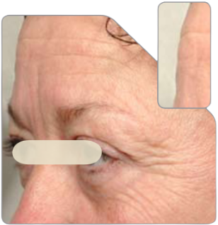 A closeup image of a middle aged woman's face, highlighting wrinkles in the forehead and eye areas.
