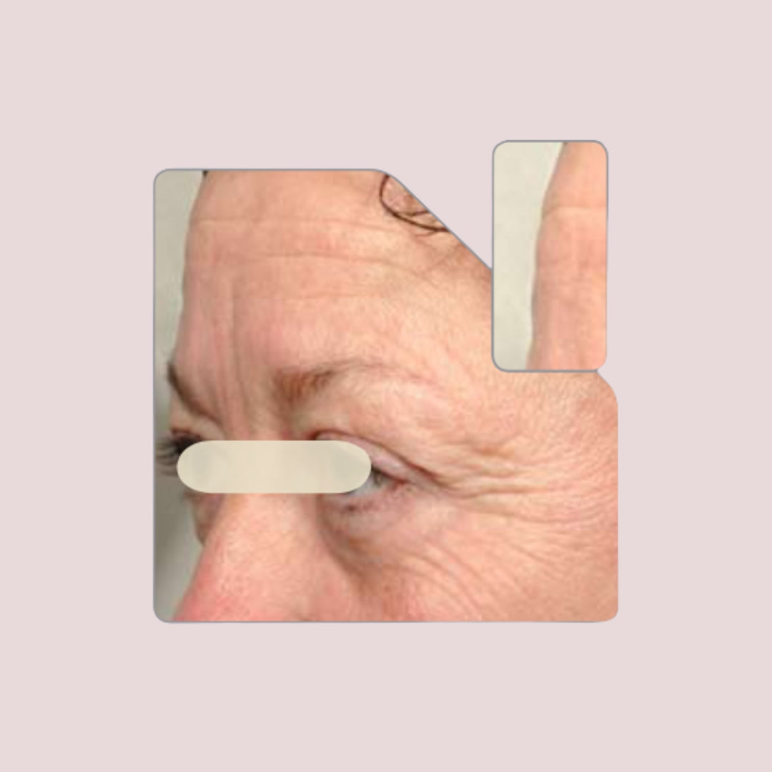 A closeup image of a middle aged woman's face, highlighting wrinkles in the forehead and eye areas.
